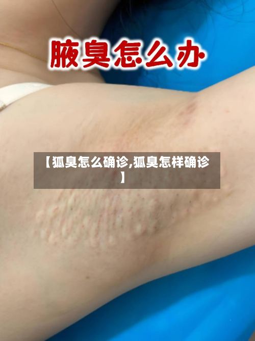 【狐臭怎么确诊,狐臭怎样确诊】